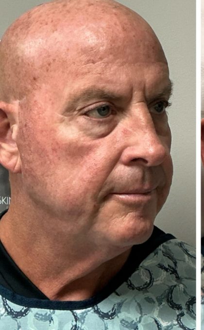 HourLift Before & After Patient #12805