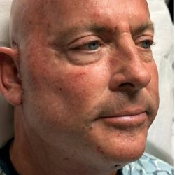 HourLift Before & After Patient #12805