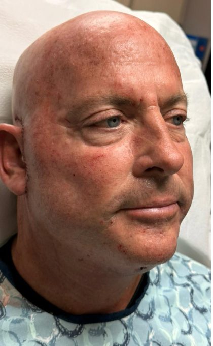 HourLift Before & After Patient #12805