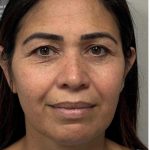 HourLift Before & After Patient #12804