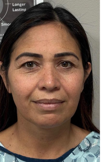 HourLift Before & After Patient #12804