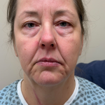 Eyelid lift Before & After Patient #12946