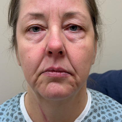 Eyelid lift Before & After Patient #12946