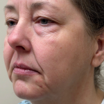 Eyelid lift Before & After Patient #12946