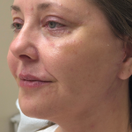 Eyelid lift Before & After Patient #12946