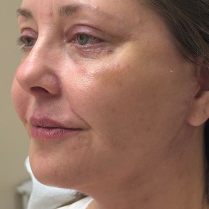 Eyelid lift Before & After Patient #12946