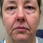 Eyelid lift Before & After Patient #12946