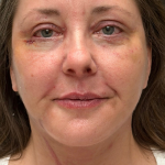Eyelid lift Before & After Patient #12946