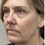 HourLift Before & After Patient #13007