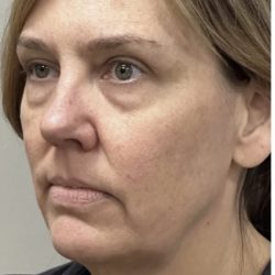 HourLift Before & After Patient #13007