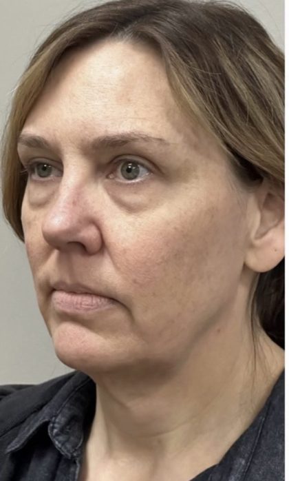 HourLift Before & After Patient #13007