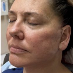 HourLift Before & After Patient #13007