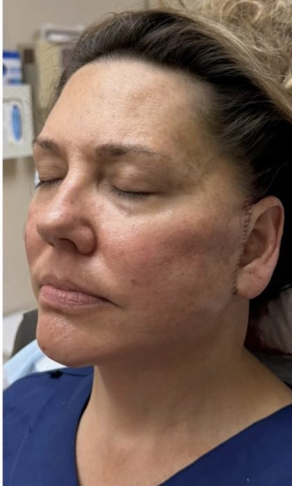 HourLift Before & After Patient #13007