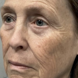 HourLift Before & After Patient #13016