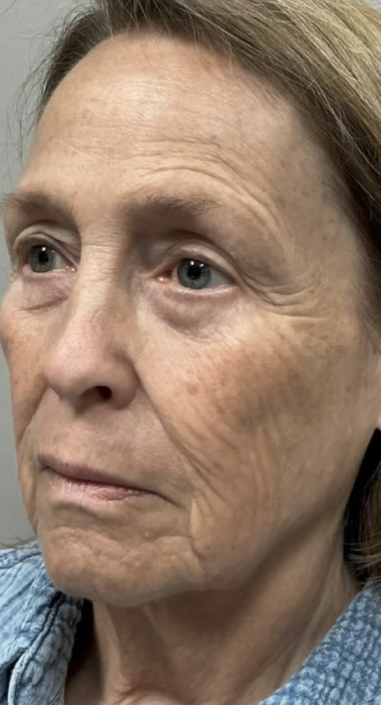 HourLift Before & After Patient #13016