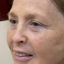 HourLift Before & After Patient #13016