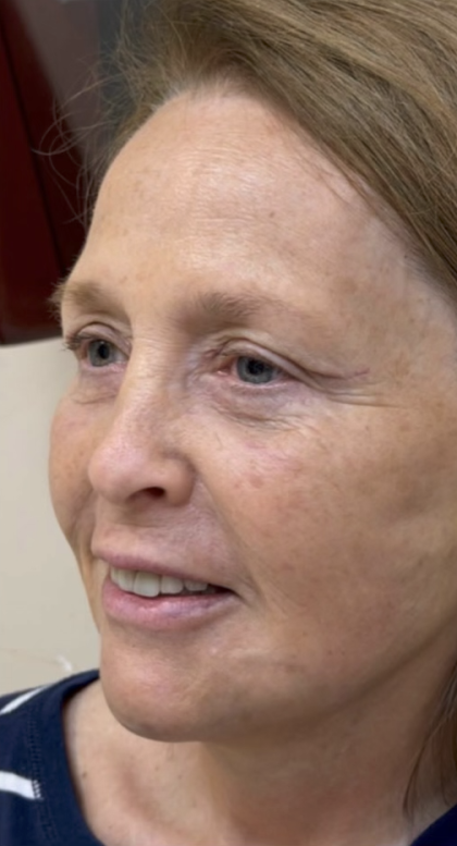 HourLift Before & After Patient #13016