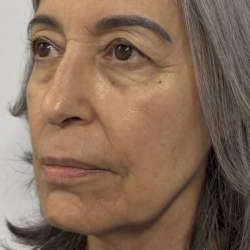 HourLift Before & After Patient #13017