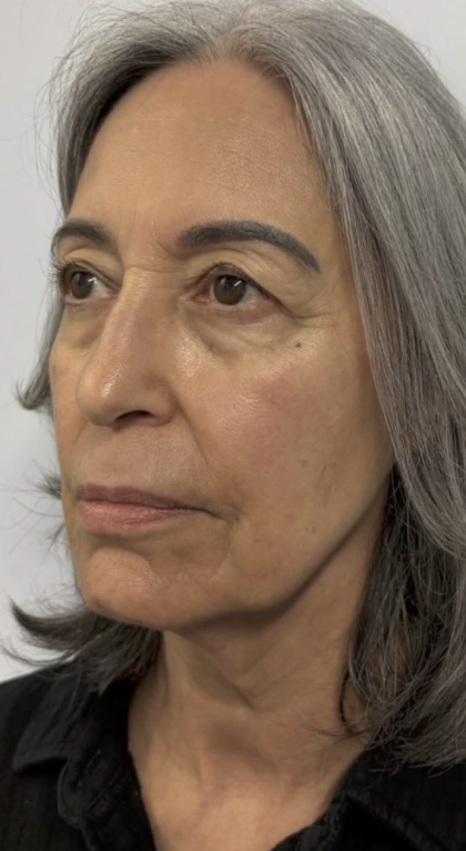 HourLift Before & After Patient #13017