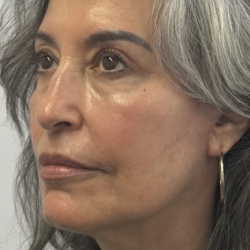HourLift Before & After Patient #13017