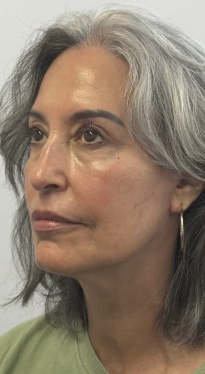 HourLift Before & After Patient #13017