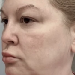 HourLift Before & After Patient #13018