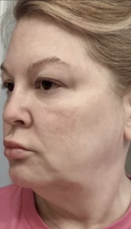 HourLift Before & After Patient #13018