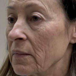 HourLift Before & After Patient #13019