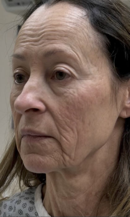 HourLift Before & After Patient #13019