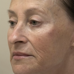 HourLift Before & After Patient #13019