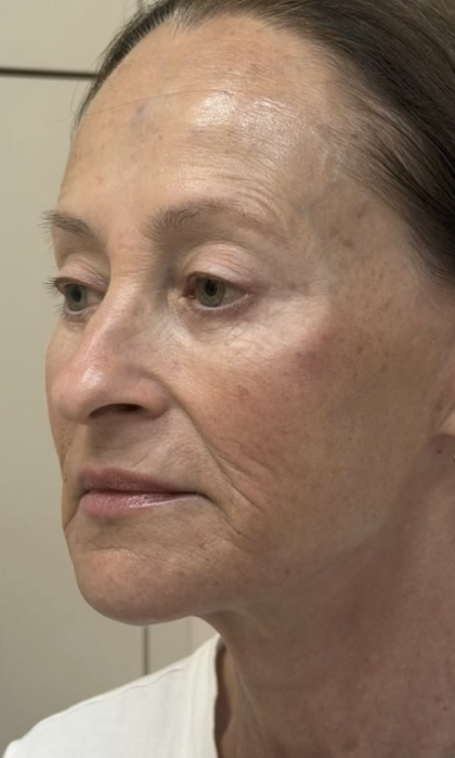 HourLift Before & After Patient #13019