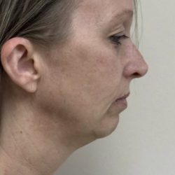 HourLift Before & After Patient #13021