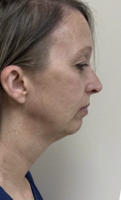 HourLift Before & After Patient #13021