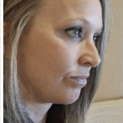 HourLift Before & After Patient #13021