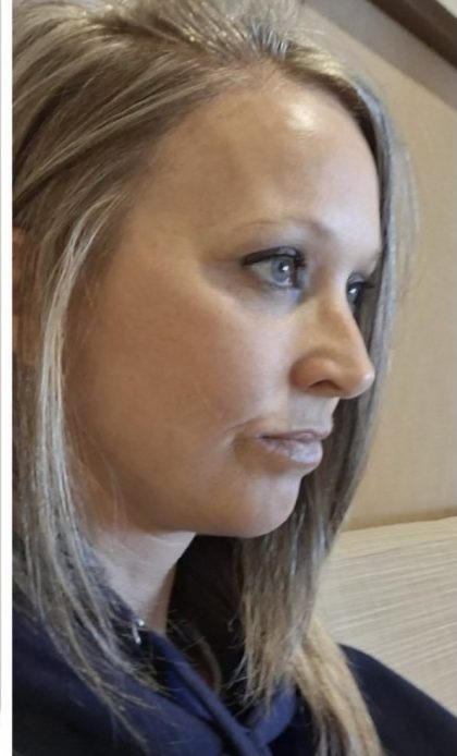 HourLift Before & After Patient #13021