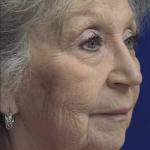 HourLift Before & After Patient #13008