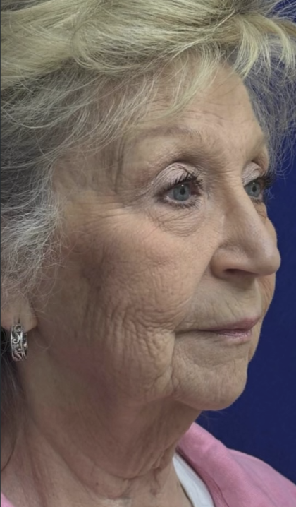 HourLift Before & After Patient #13008