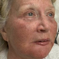 HourLift Before & After Patient #13008