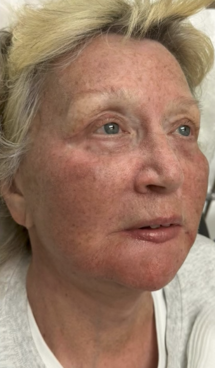 HourLift Before & After Patient #13008