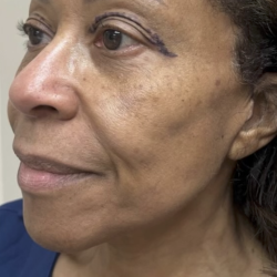 HourLift Before & After Patient #13009