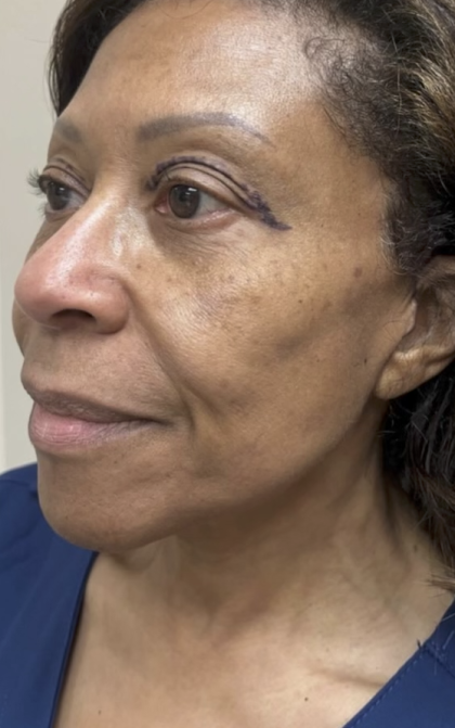 HourLift Before & After Patient #13009