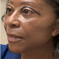HourLift Before & After Patient #13009