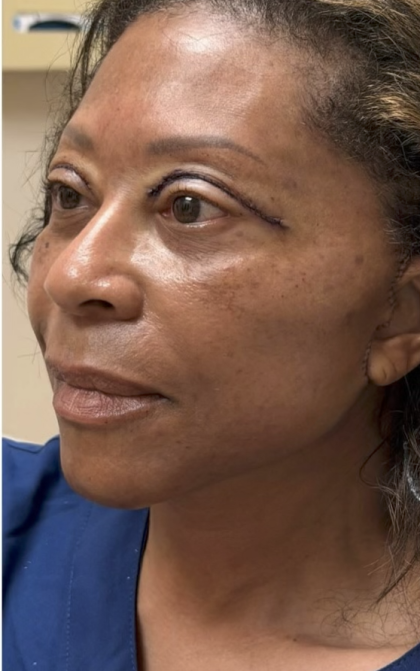 HourLift Before & After Patient #13009