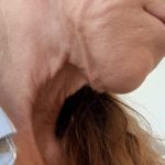 HourLift Before & After Patient #13010