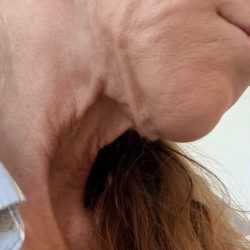 HourLift Before & After Patient #13010