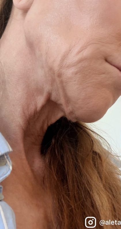 HourLift Before & After Patient #13010