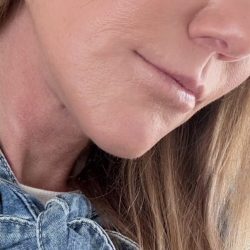 HourLift Before & After Patient #13010