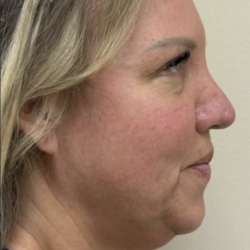 HourLift Before & After Patient #13012