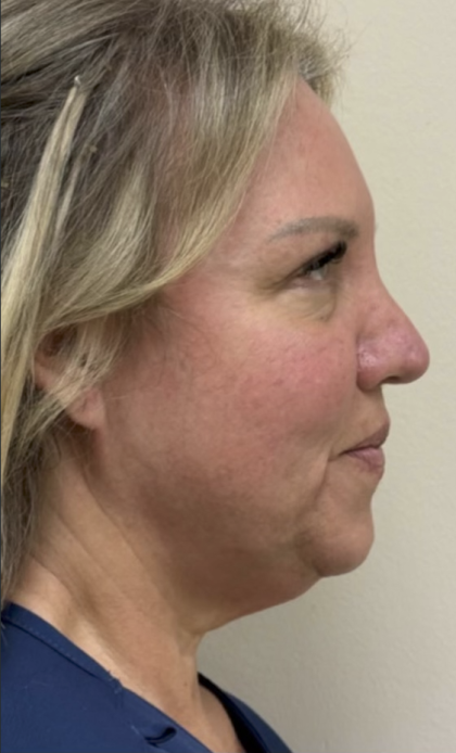 HourLift Before & After Patient #13012