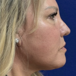HourLift Before & After Patient #13012